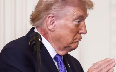 Mėlynės ant rankų ir vizitai ligoninėje: viešojoje erdvėje aštrėja klausimai dėl D. Trumpo sveikatos