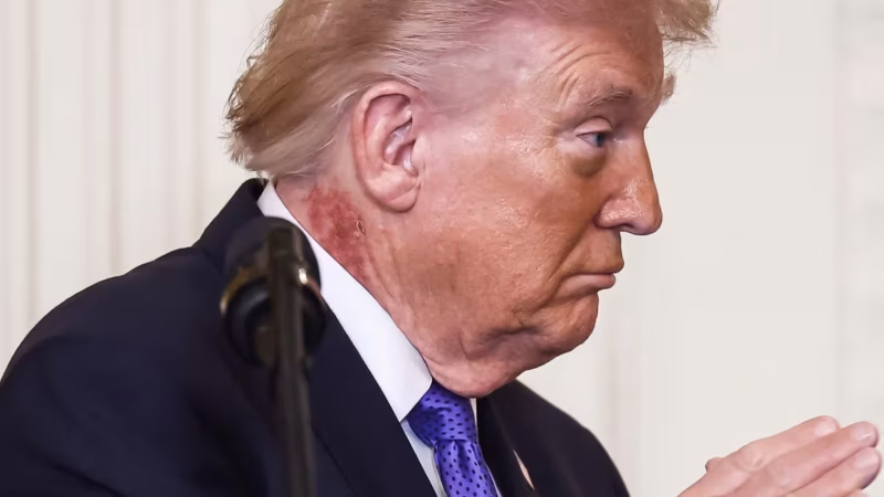 Mėlynės ant rankų ir vizitai ligoninėje: viešojoje erdvėje aštrėja klausimai dėl D. Trumpo sveikatos