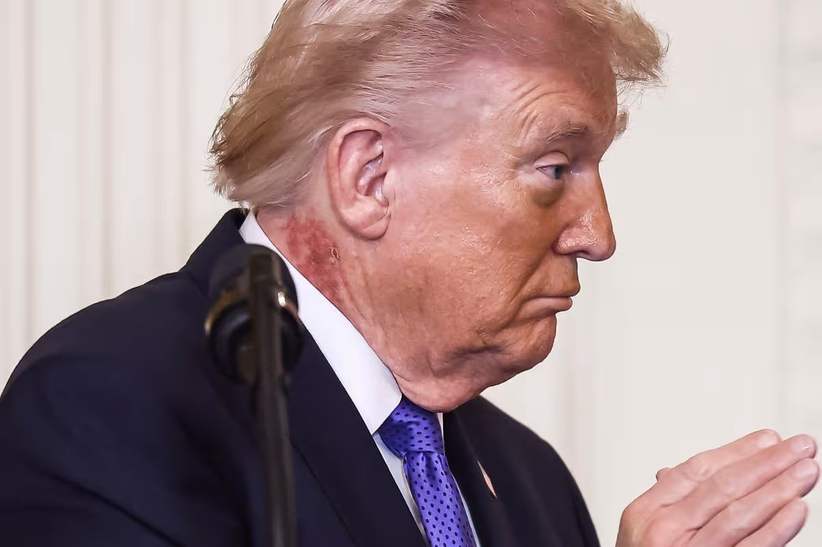 Mėlynės ant rankų ir vizitai ligoninėje: viešojoje erdvėje aštrėja klausimai dėl D. Trumpo sveikatos